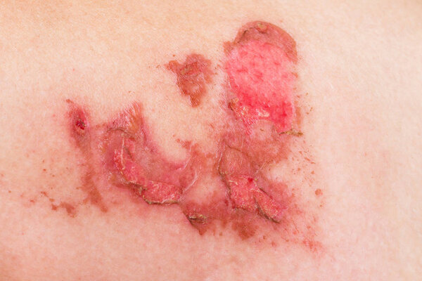 Wound on the skin of the leg, obtained from burns