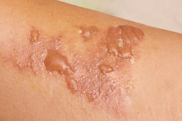 Skin burn on the leg of a young woman
