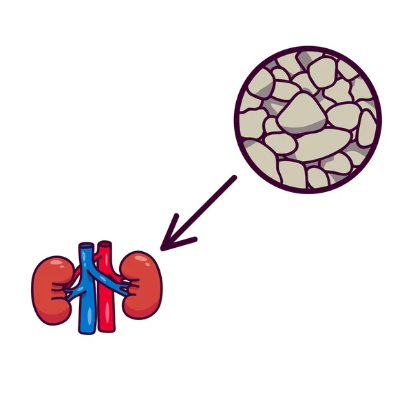 人間の腎臓に石が入ってる 生殖器系の病気の臓器 腎臓病だ 小児医学書のポスター — ストックベクタ