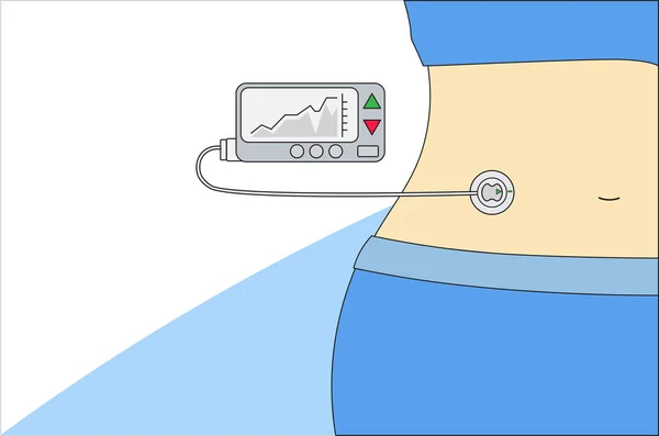 Insulin pump machinery diabetes connected in his abdomen and empty top space for text. — Stock Vector