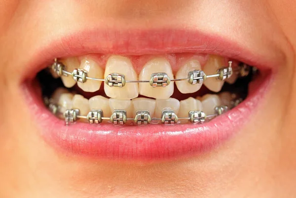 Dental Brace Retainer Closeup Royalty Free Stock Images