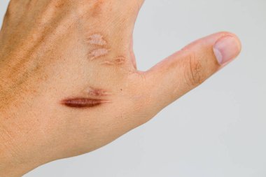 Keloid yara izi (Hipertrofik Yara) kaza dan sonra erkek el derisi. araba kazara cerrahi ile bilek derisinde keloidal yara neden , iyileşmiş bir cilt yaralanması yerinde yara bir tür oluşumudur.