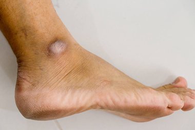 Kapalı-up bir kuru ve çatlak topuk, beyaz arka plan üzerinde çatlak topuk