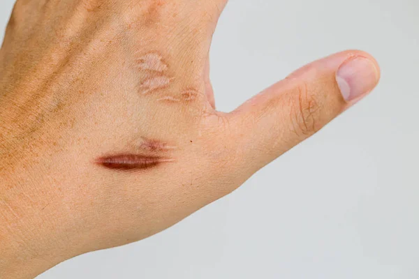 Blizny Keloid Hipertroficzne Blizny Człowieka Skóry Rąk Wypadku Blizny Keloidalnej — Zdjęcie stockowe