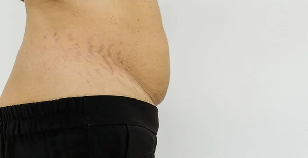 Belly Pattern fat stomach woman. Abdominal scar marked pattern. Pregnant women with striped belly