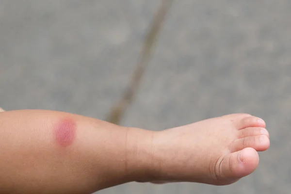 孩子咬了一只蚊子的腿 婴儿出生时因蚊虫叮咬而有红斑 儿童腿对昆虫叮咬过敏 — 图库照片