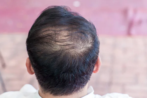 Close up hair loss, thinning hair and scalp issue. hair loss treatment.head with loss symptoms. Bald treatment. Bald hair of male heredity