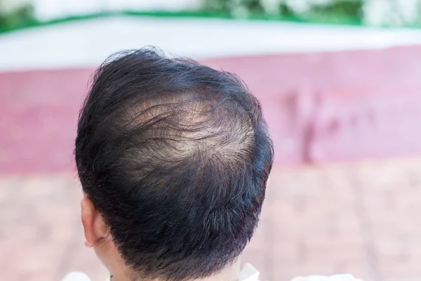 クローズアップ脱毛 薄毛と頭皮の問題 脱毛治療 損失症状を伴う頭部 ハゲの治療 男性の遺伝のはげ毛 — ストック写真