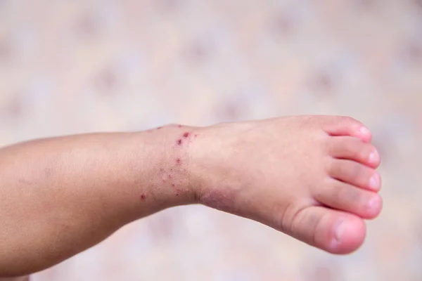 Boy with symptoms hand, foot and mouth disease . children 