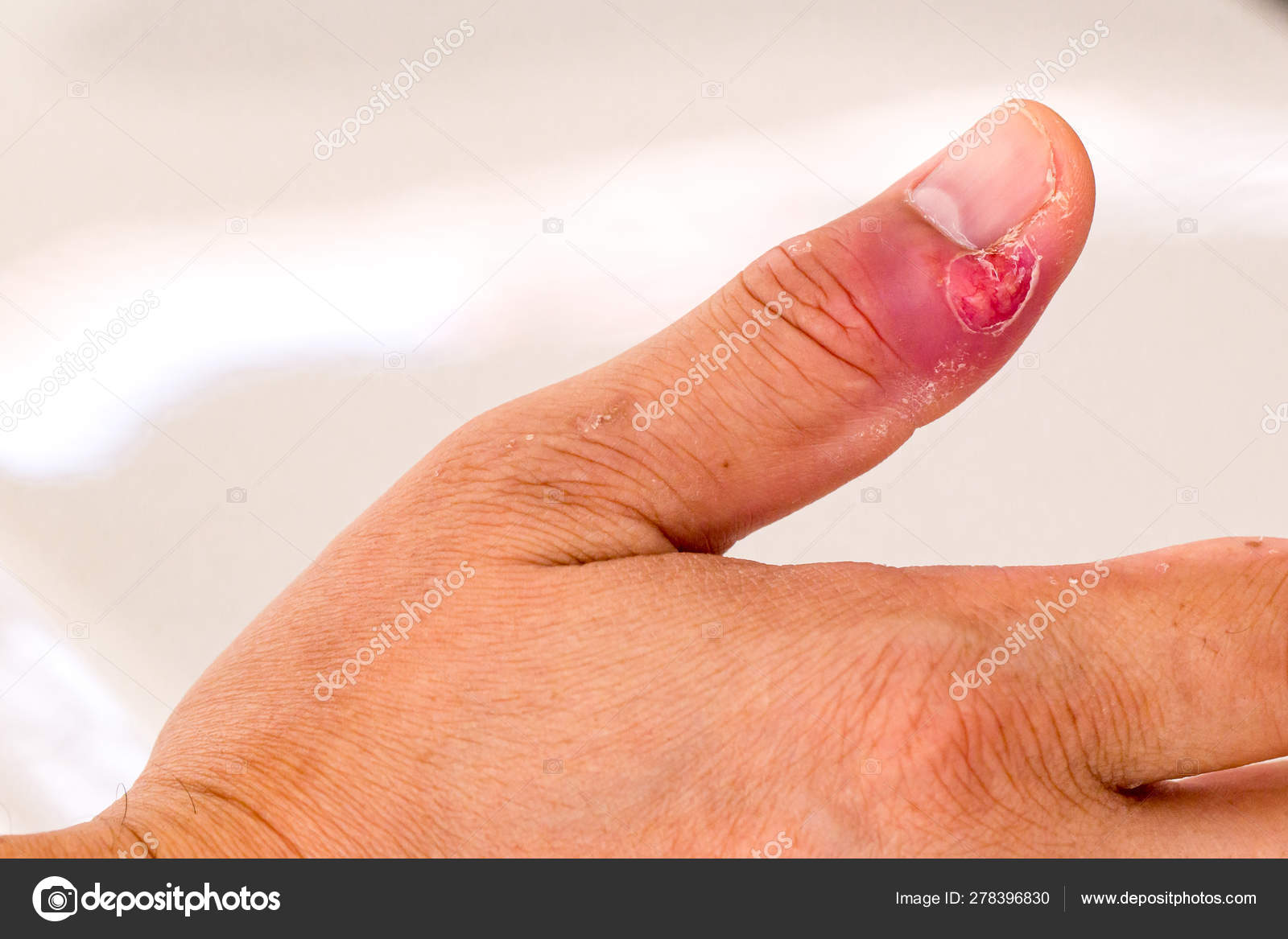 Home Remedies: Just jammed your finger? - Mayo Clinic News Network