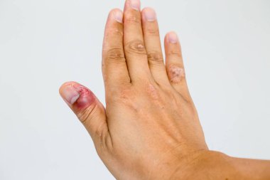 Paronychia, küçük çocuklar elinde bakteriyel enfeksiyon nedeniyle tırnak yatağı iltihabı ile şişmiş parmak. Tırnak yırtık enfeksiyon nedeniyle iltihap ile şişmiş parmak.