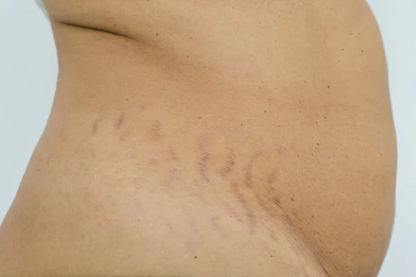 Belly Pattern Gros Ventre Femme Cicatrice Abdominale Marquée Femmes Enceintes — Photo