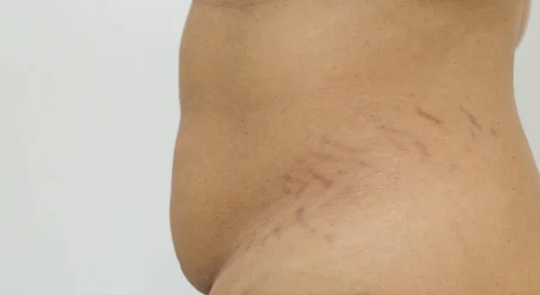 Belly Pattern fat stomach woman. Abdominal scar marked pattern. Pregnant women with striped belly