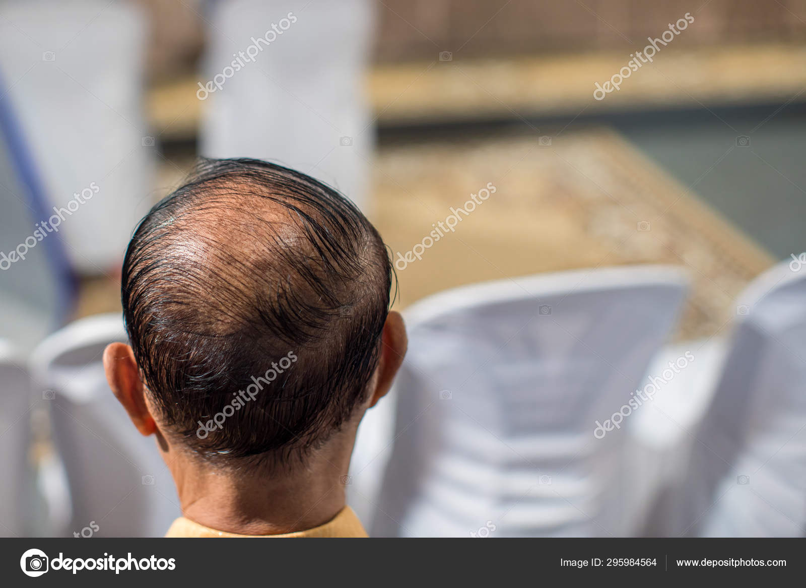Close Hair Loss Thinning Hair Scalp Issue Hair Loss Treatment
