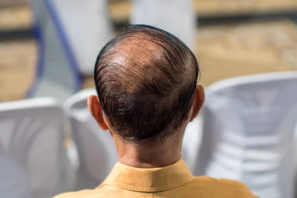 Saç Dökülmesi Inceltme Saç Kafa Derisi Sorunu Kadar Kapatın Saç — Stok fotoğraf