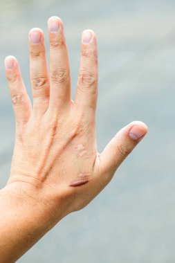 Keloid yara izi (Hipertrofik Yara) kaza dan sonra erkek el derisi. araba kazara cerrahi ile bilek derisinde keloidal yara neden , iyileşmiş bir cilt yaralanması yerinde yara bir tür oluşumudur.