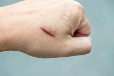 Keloid yara izi (Hipertrofik Yara) kaza dan sonra erkek el derisi. araba kazara cerrahi ile bilek derisinde keloidal yara neden , iyileşmiş bir cilt yaralanması yerinde yara bir tür oluşumudur.