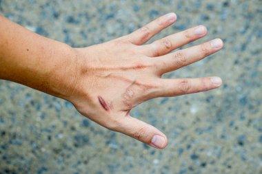 Keloid yara izi (Hipertrofik Yara) kaza dan sonra erkek el derisi. araba kazara cerrahi ile bilek derisinde keloidal yara neden , iyileşmiş bir cilt yaralanması yerinde yara bir tür oluşumudur.