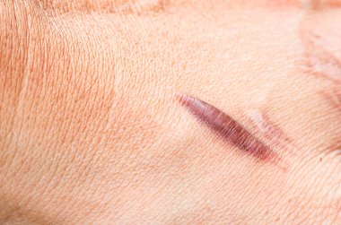 Keloid yara izi (Hipertrofik Yara) kaza dan sonra erkek el derisi. araba kazara cerrahi ile bilek derisinde keloidal yara neden , iyileşmiş bir cilt yaralanması yerinde yara bir tür oluşumudur.