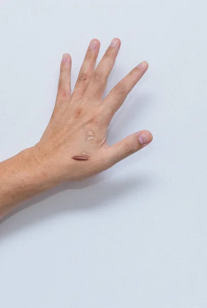 Keloid scar (Hypertrophic Scar) on man hand skin after accident. keloidal scar on wrist skin cause by surgery in car accidental , is a formation of a type of scar at the site of a healed skin injury.