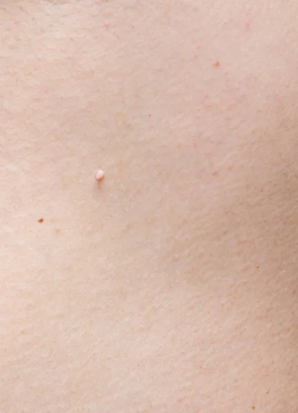 Pedunculated skin tag or acrochondon or soft fibroma. papilloma on human skin. Wart. Dermatological problem.mole on body , removal of moles nevus or warts concept