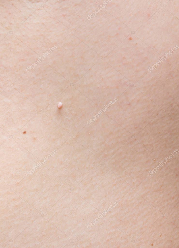 papilloma fibroma