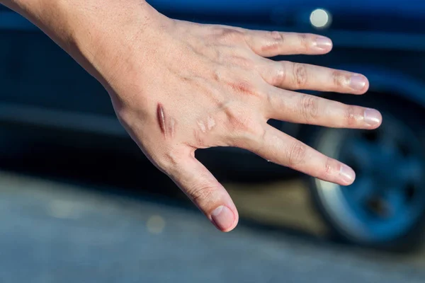 Keloid scar (Hypertrophic Scar) on man hand skin after accident. keloidal scar on wrist skin cause by surgery in car accidental