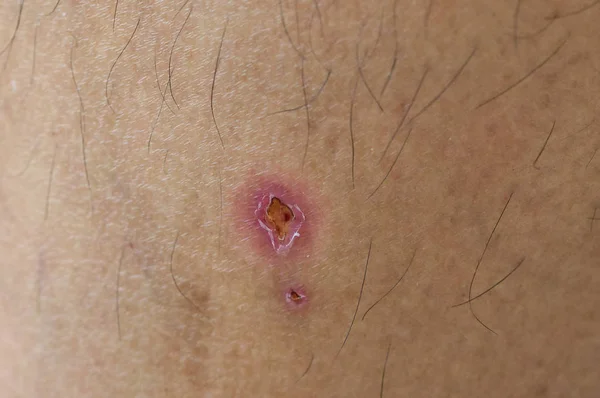 Infección Heridas Piel Una Herida Cuerpo Humano Sutura Vieja Corte — Foto de Stock