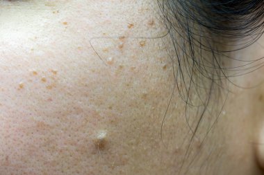 Yüzünde güneş ışığından kaynaklanan çiller. Asyalı Kadın Yüzünde çiller, Cilt Sorunları. Asyalı Kadın Yüzü Yüzündeki Çiller, Cilt Sorunları