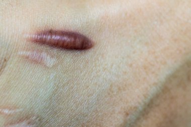 Keloid yara izi (Hipertrofik Yara) kaza dan sonra erkek el derisi. araba kazara cerrahi ile bilek derisinde keloidal yara neden , iyileşmiş bir cilt yaralanması yerinde yara bir tür oluşumudur.