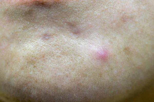 Foto Nodular Cystic Acne Skin Kulit Jerawat Kronis Pada Permukaan — Stok Foto