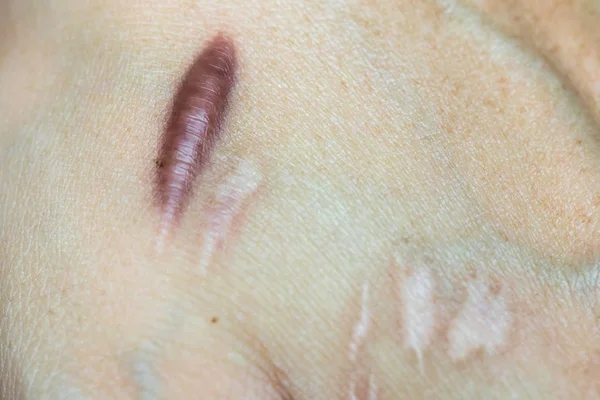 Keloid Scar Hipertrófiás Scar Ember Keze Bőr Baleset Után Keloid — Stock Fotó