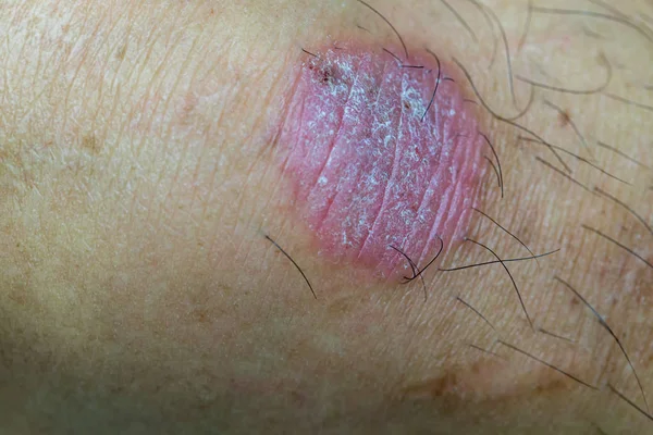 Infection Par Ver Annulaire Dermatophytose Cutanée Infection Par Teigne Tinea — Photo