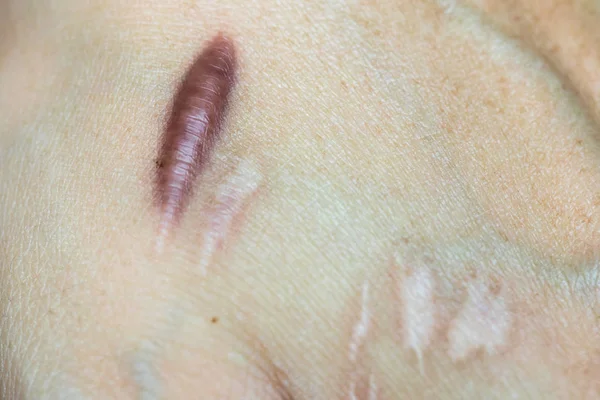 Keloid scar (Hypertrophic Scar) on man hand skin after accident. keloidal scar on wrist skin cause by surgery in car accidental , is a formation of a type of scar at the site of a healed skin injury.