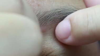 Sivilceyi vücuttan çıkarıyorum. Sivilce iltihabı Yüzündeki sivilceleri ezer. Yağlı cilt. Sorunlu cilt. Sivilceye yatkın deri fotoğrafını kapat.