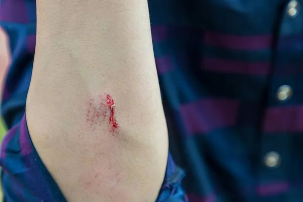 Травми Від Падіння Саду Чоловік Показує Пошкодження Руці Рука Поранена — стокове фото