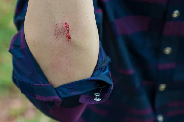 Bahçede Düşerken Yaralanmış Kolunda Lezyon Gösteren Bir Adam Kol Bıçakla — Stok fotoğraf