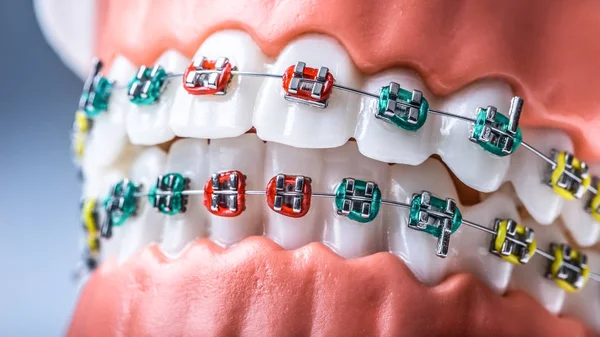 Close Van Een Orthodontische Model Kaken Tanden Met Bretels — Stockfoto