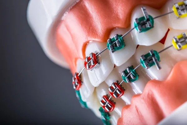 Szczegół Ortodontyczne Model Szczęki Zęby Szelkami — Zdjęcie stockowe