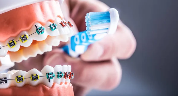 Close Aparelhos Dentes Escova Dentes Como Exemplo Escovação Dentes — Fotografia de Stock