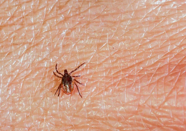 A predatory tick crawls along the human skin. Closeup, top view.