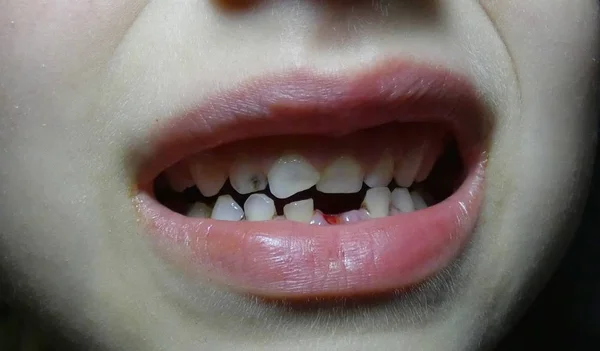 Złe Zęby Dziecka Upadłego Zęba — Zdjęcie stockowe