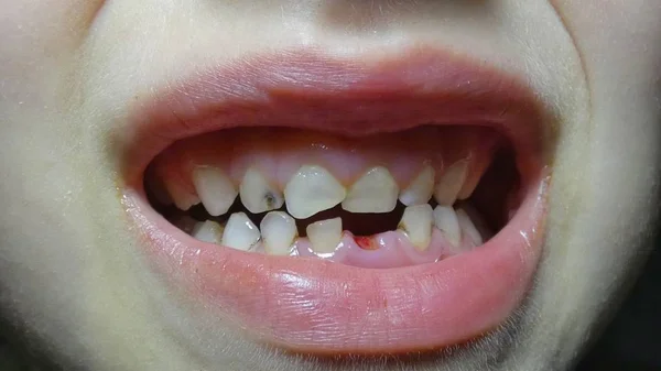 悪い赤ちゃんの歯 落ちた歯 — ストック写真
