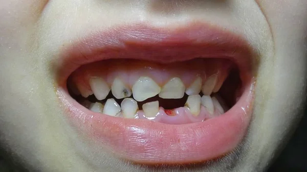 bad baby teeth. fallen tooth