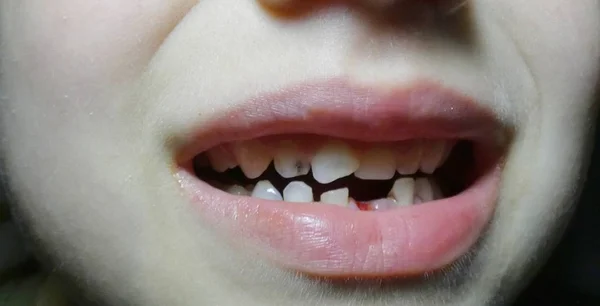 Slechte Baby Tanden Gevallen Tand — Stockfoto