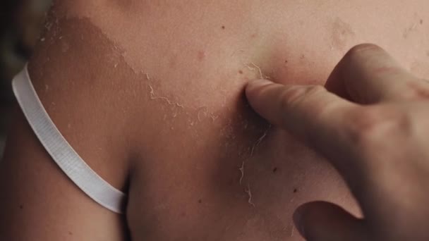 Extracción de la piel descamada de una quemadura solar. Retire la piel descamada después de la quemadura — Vídeos de Stock
