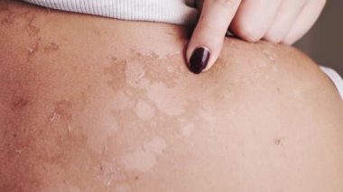 Solaryum sonrası kaşınan, kırmızı tenli bir kadın.