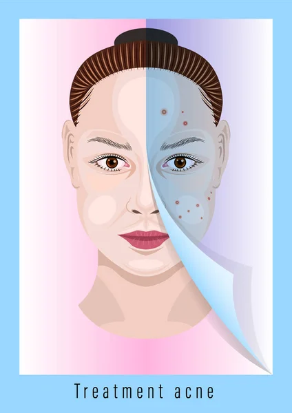 Woman face before and after treatment acne — Stock Vector