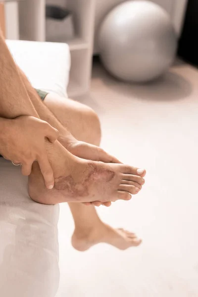 Ruce Dospělého Muže Zraněnou Nebo Popálenou Nohou Sedí Gauči Čeká — Stock fotografie