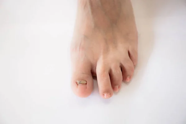 tırnak mantar enfeksiyonu